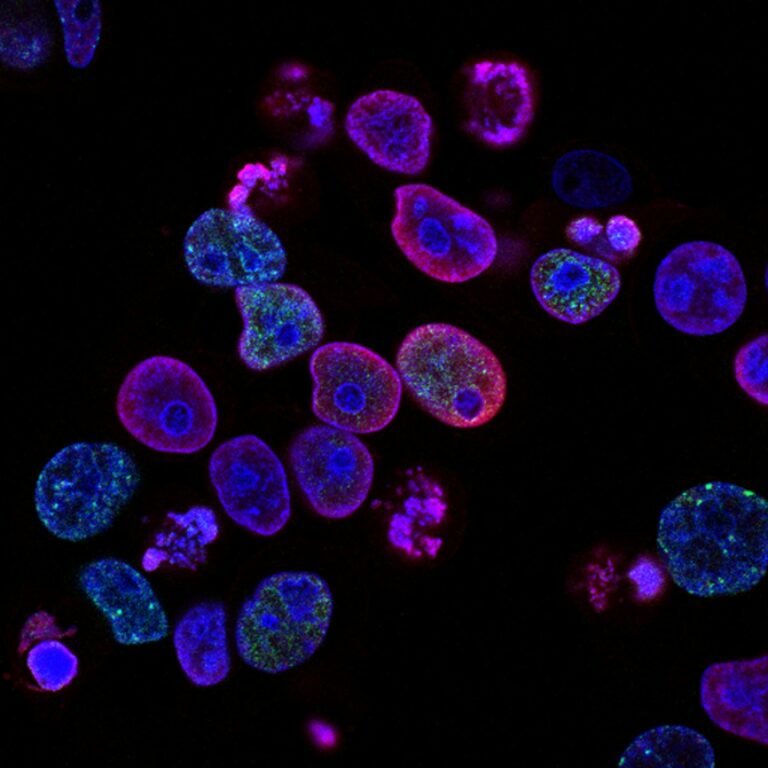 Human colorectal cancer cells treated with a topoisomerase inhibitor and an inhibitor of the protein kinase ATR (ataxia telangiectasia and Rad3 related), a drug